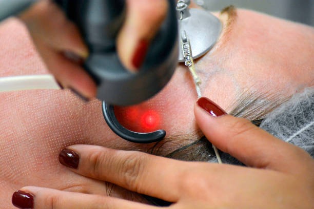 Laser Treatment for Face: Understanding Modern Solutions for Skin Rejuvenation